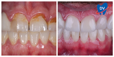 Before & After: Dental Veneers in Cali