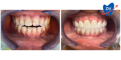 Before & After: Dental Veneers in Split