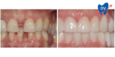 Before & After: Orthodontic Treatment in Trogir