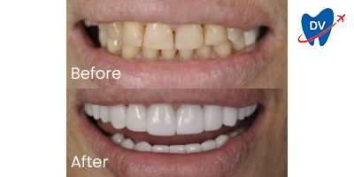 Before & After: Teeth Whitening in Barranquilla