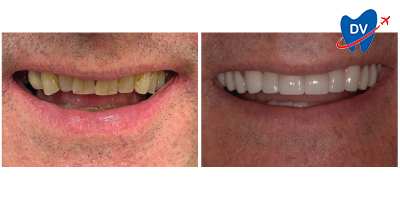 Before & After: Zirconia Dental Crowns in Trogir