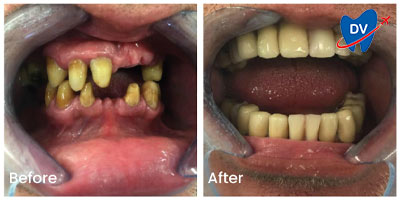 Full mouth restoration in Greece - Before & after