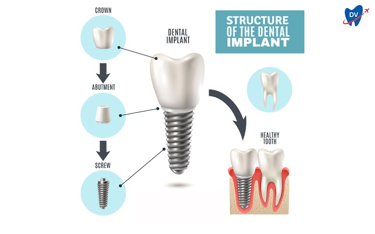 Dental Implant