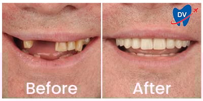 Dental Implants in Istanbul