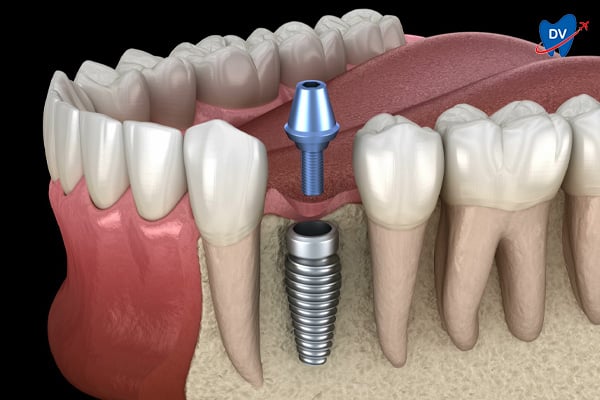 Abutment Fixation