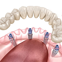 All on 4 Dental Implants in Constanta