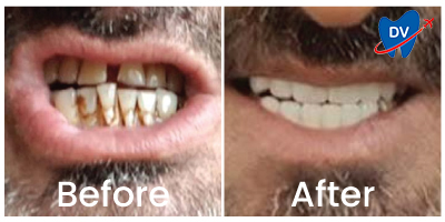 Full Mouth Restoration in Istanbul