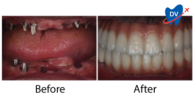 Before & After Dental Implants in Izmir, Turkey