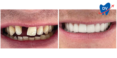 Before & After: Dental Implants in Antalya