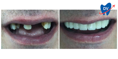 Before & After: Dental Implants in Tirana