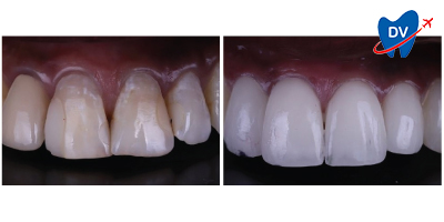 Before & After: Dental Veneers in Ankara