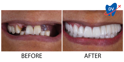 Dental Implants in Turkey | Before & After