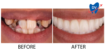 Dental Implants in Turkey | Before & After