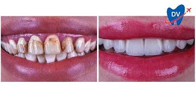 Smile Makeover in Turkey Before and After