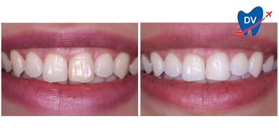 Before & After: Teeth Whitening in Ankara