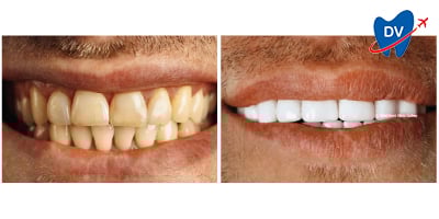 Teeth Whitening in Turkey Before and After