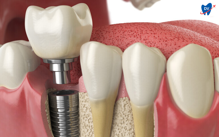 Dental Implant As Natural Tooth Root