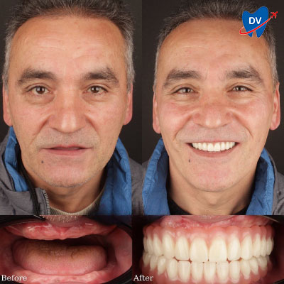 Full Mouth Implants in Turkey (Before & After)