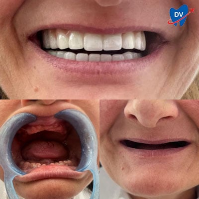 Full Mouth Implants in Turkey (Before & After)