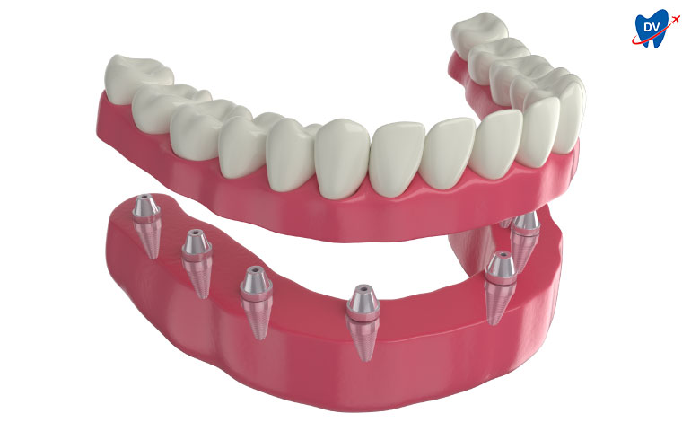 Dental Implants for Full Mouth reconstruction Los Algodones