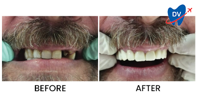 Before/After Dental Implants in Dubrovnik