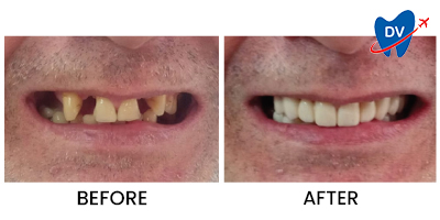 Before/ After Dental Implants in Dubrovnik
