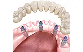 All-on-4 Dental Implants in Turkey