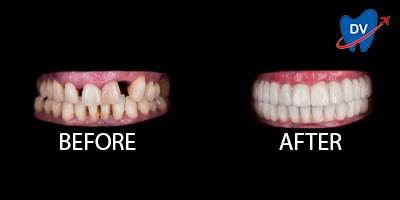 Dental Bridge in Moldova: Before & After