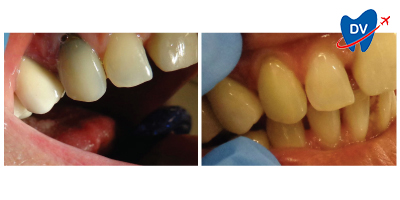Before & After: Zirconia Crowns in Greece
