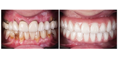 dental implants and smile makeover