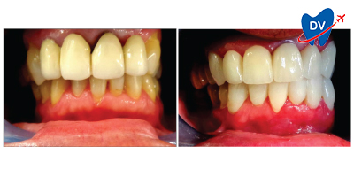 Before & After: Dental Bridge in Greece 