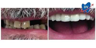 Before & After: Dental Implants in Zagreb