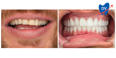 Dental veneers in Romania - Before & After