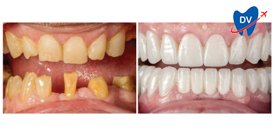 Full mouth rehabiltation in Romania - Before & After