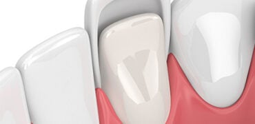 Emax Veneers
