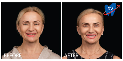 Dental Crowns in Moldova - Before & After
