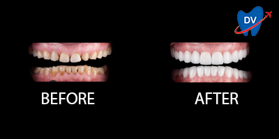 Dental Crowns in Moldova - Before & After