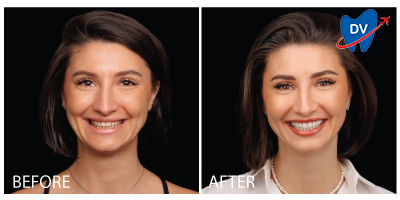 Dental Veneers in Moldova Before & After