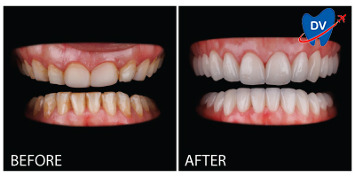 Dental Veneers in Moldova Before & After