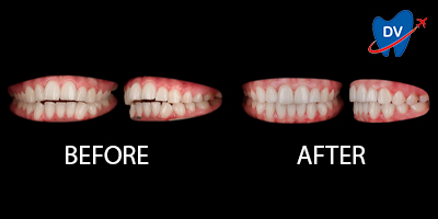 Orthodontic treatment in Moldova- Before & After