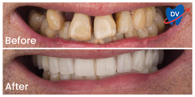 Before & After Dental Implants in Turkey