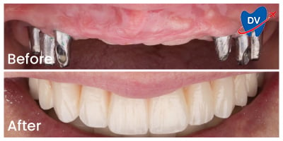 Full Mouth Implants in Turkey: Before & After