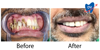 Before & After Dental Implants in Sri Lanka