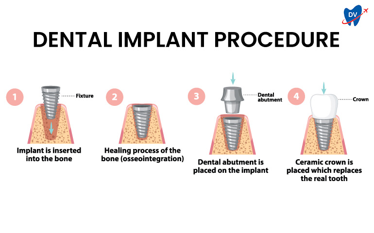 Steps in dental implant procedure