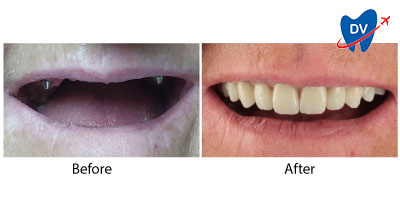 All on 4 Dental Implants in Constanta, Romania: Before & After