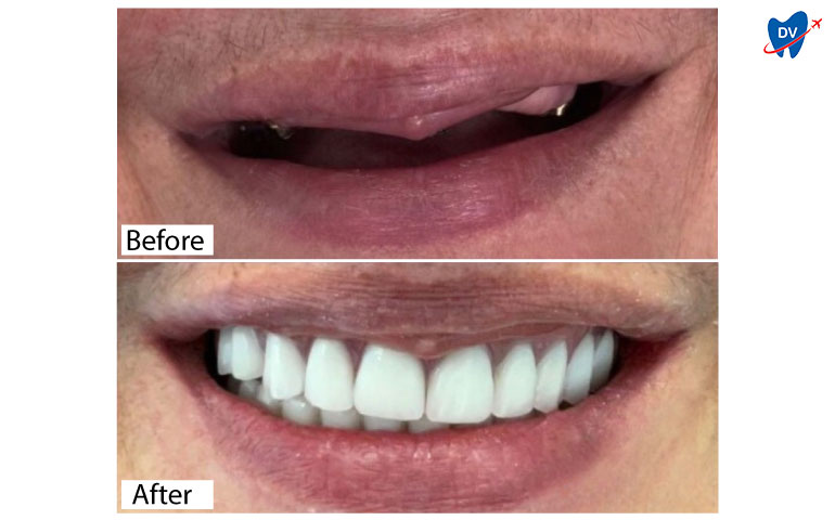 Before After Dental Implants in Tirana 