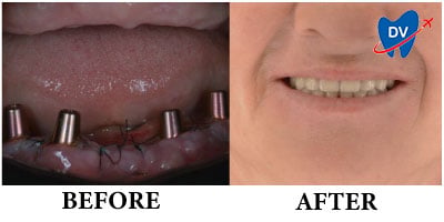 Before & After Full Mouth Dental Implants in Romania