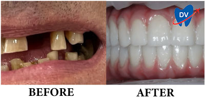 Before & After Full Mouth Dental Implants in Romania