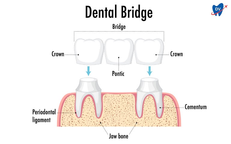 Dental Bridge in Turkey