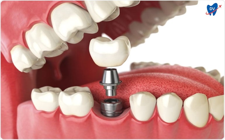 Single Tooth Implant in Ankara, Turkey